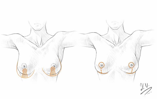 Breast Reduction