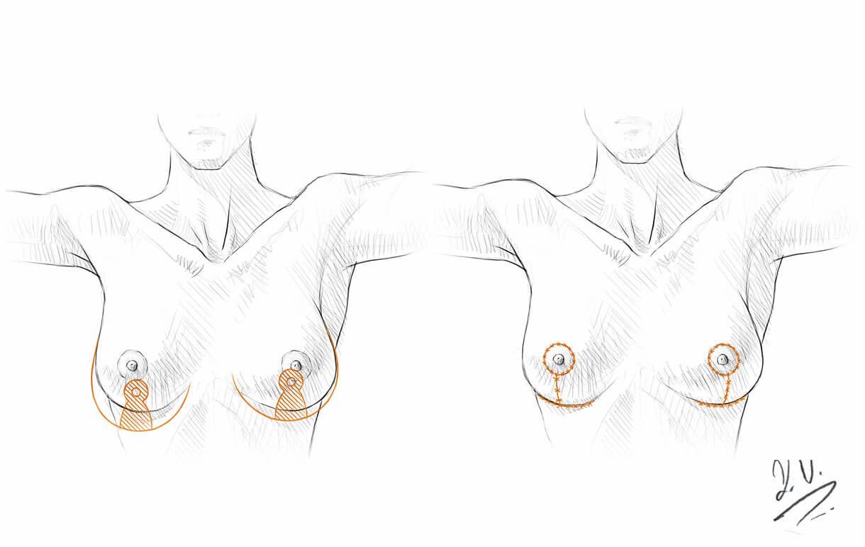 Breast Reduction