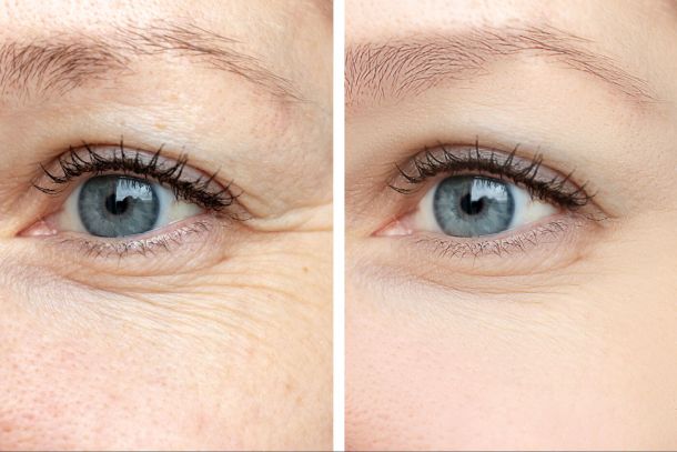 Was macht eine Augenlidstraffung so beliebt