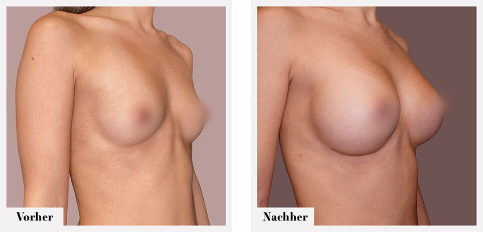 Brustvergrösserung vorher nachher implantate