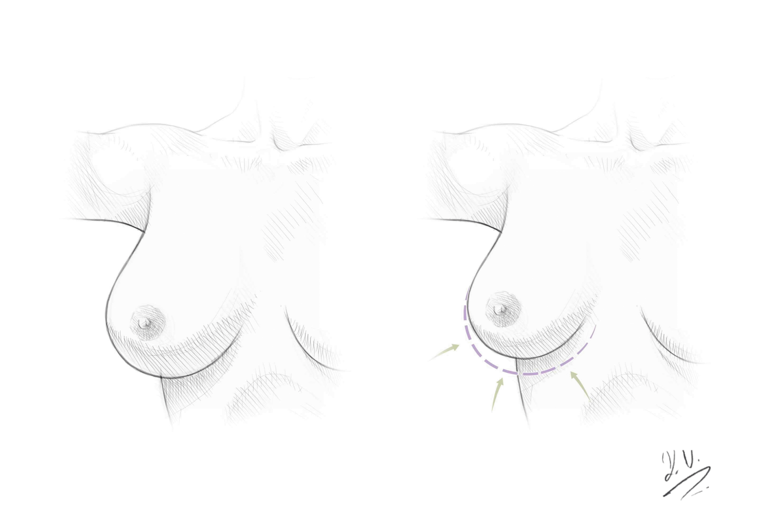 Brustverkleinerung Narben Zug