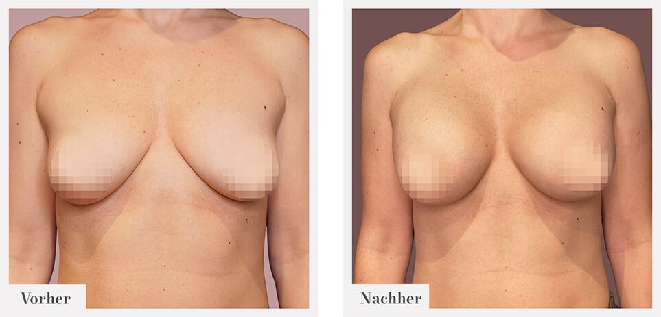 breast lift zug before after