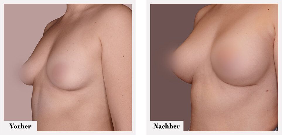 Brustvergrösserung vorher nachher implantate