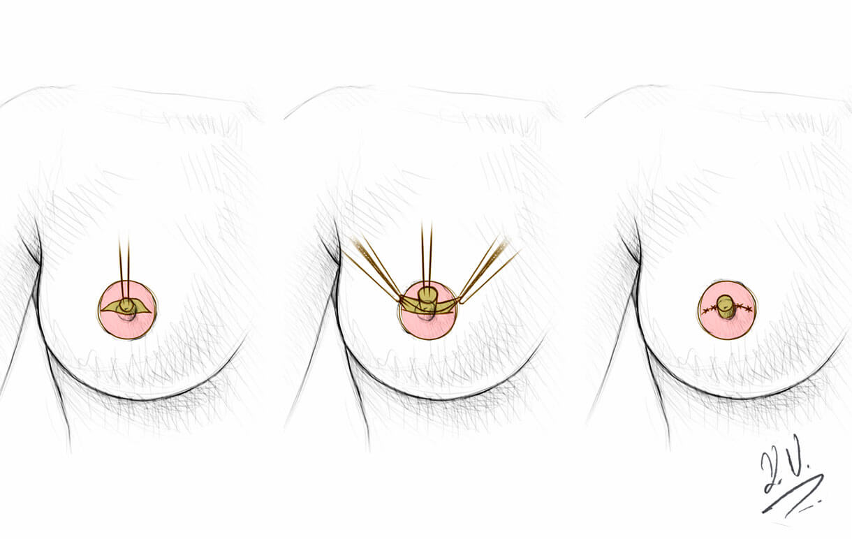 Brustwarzenkorrektur zug