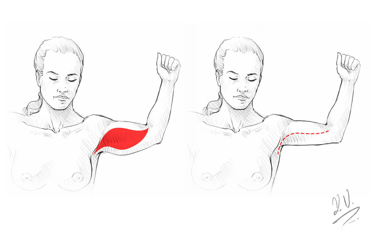 oberarmstraffung-in-zug