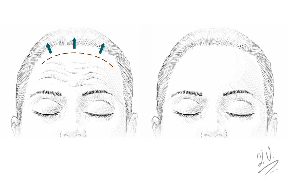 Augenbrauenlift