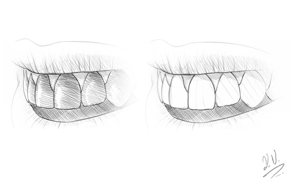 LED teeth whitening (tooth bleaching): up to 16 levels improvement for white teeth.