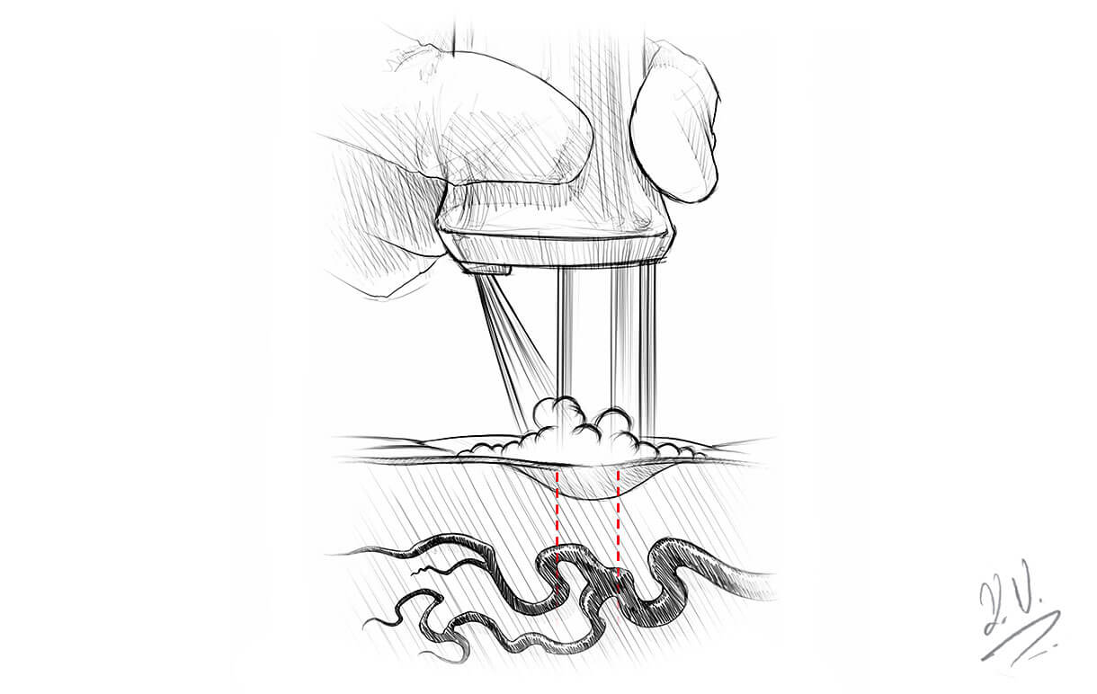 SHR Laser Haarentfernung in Zug