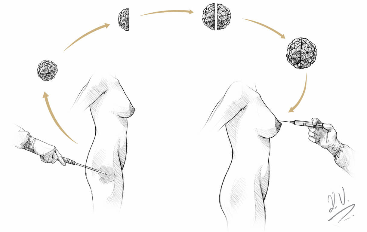 Breast augmentation with lipofilling