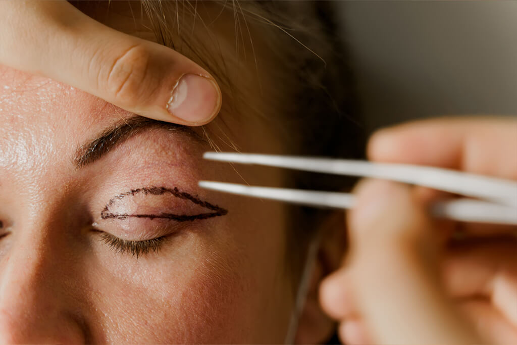 Augenlid mit Markierungen für eine Augenlidstraffung