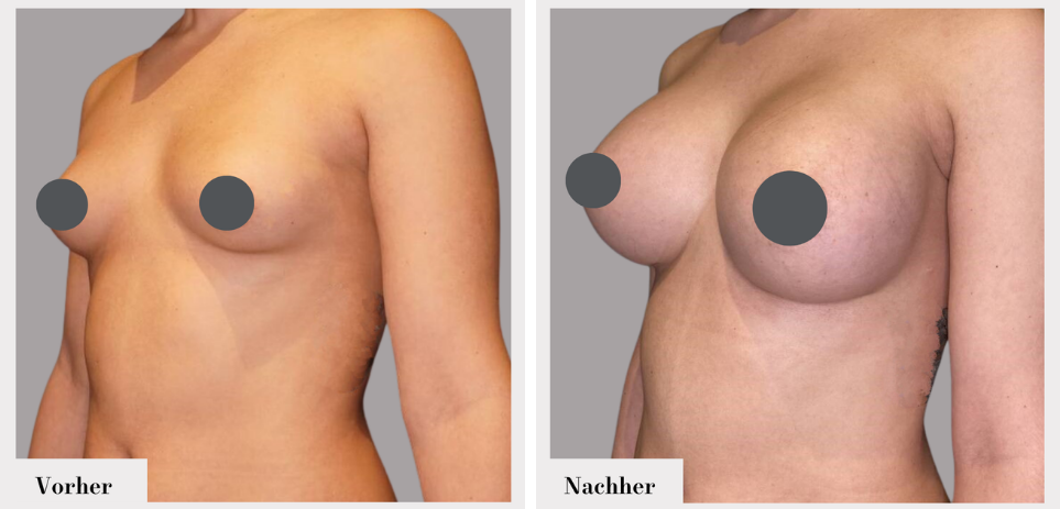 Brustvergrösserung vorher nachher implantate