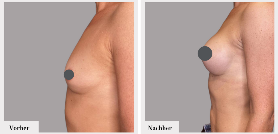Brustvergrösserung vorher nachher implantate