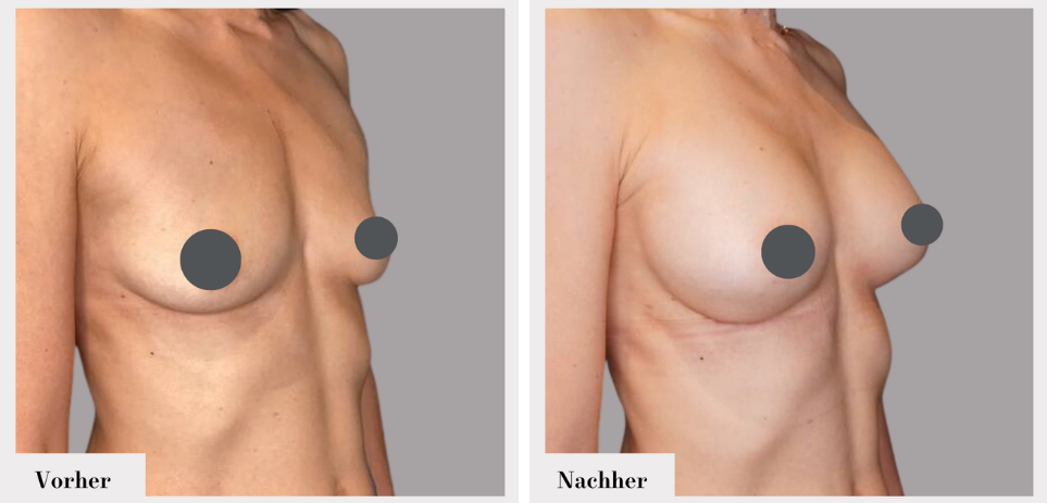 Brustvergrösserung vorher nachher implantate
