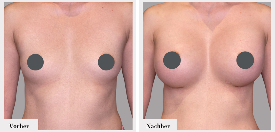 Brustvergrösserung vorher nachher implantate