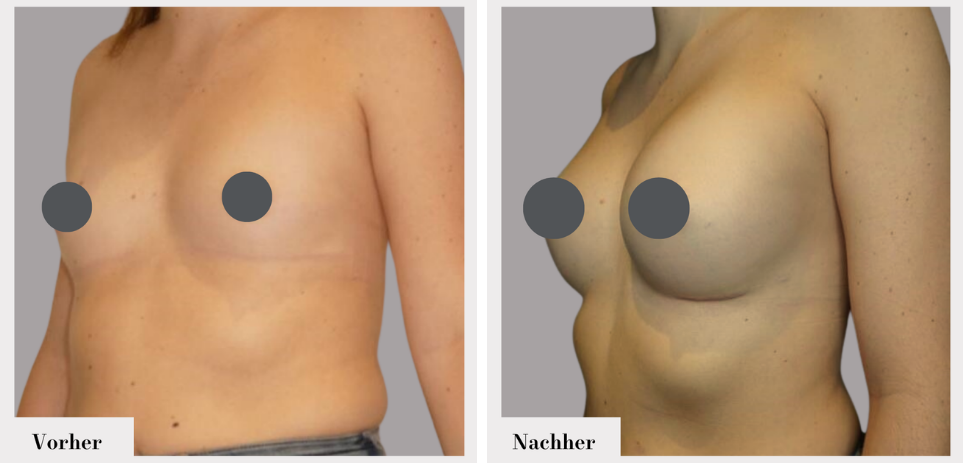 Brustvergrösserung vorher nachher implantate