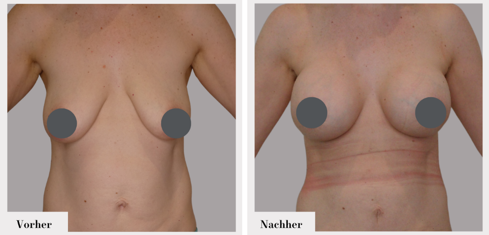 Brustvergrösserung vorher nachher implantate