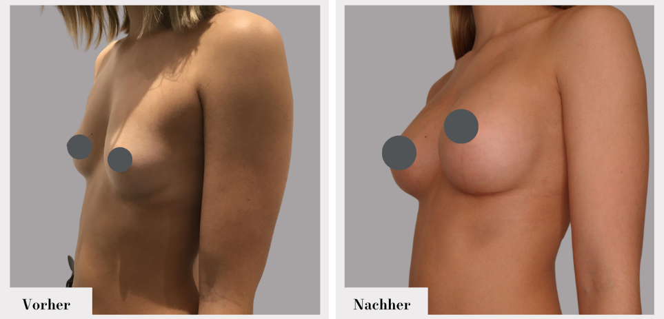 Brustvergrösserung vorher nachher implantate