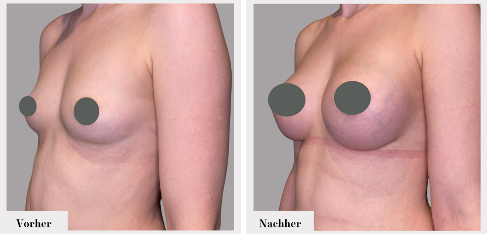 Brustvergrösserung vorher nachher implantate
