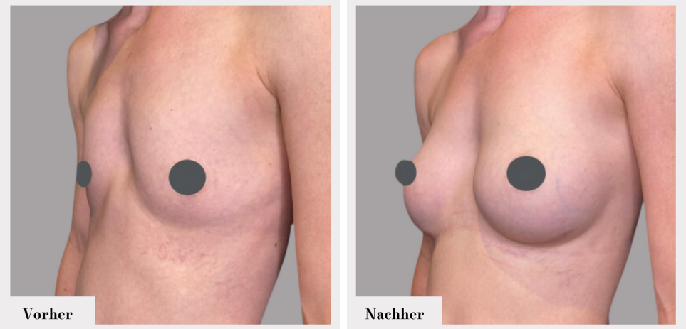 Brustvergrösserung vorher nachher implantate