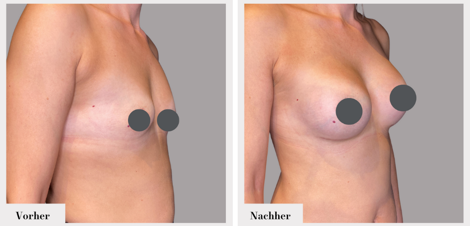 Brustvergrösserung vorher nachher implantate