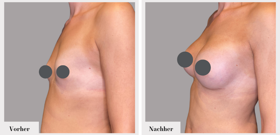 Brustvergrösserung vorher nachher implantate