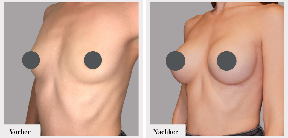 Brustvergrösserung vorher nachher implantate