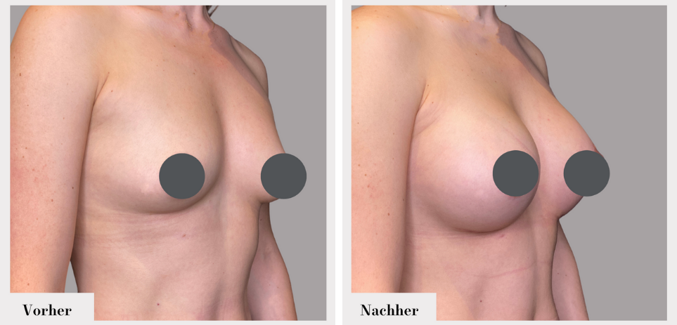 Brustvergrösserung vorher nachher implantate