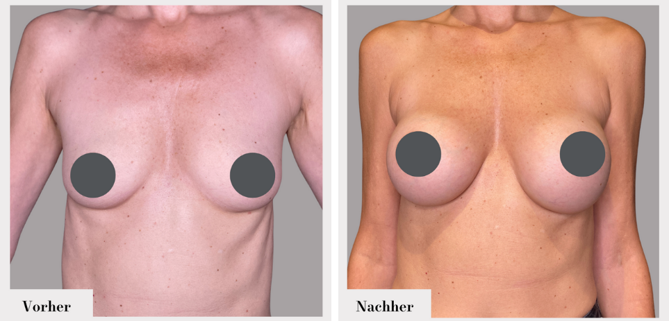 Brustvergrösserung vorher nachher implantate