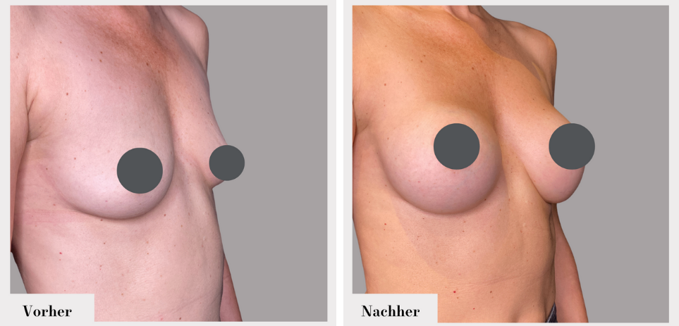 Brustvergrösserung vorher nachher implantate