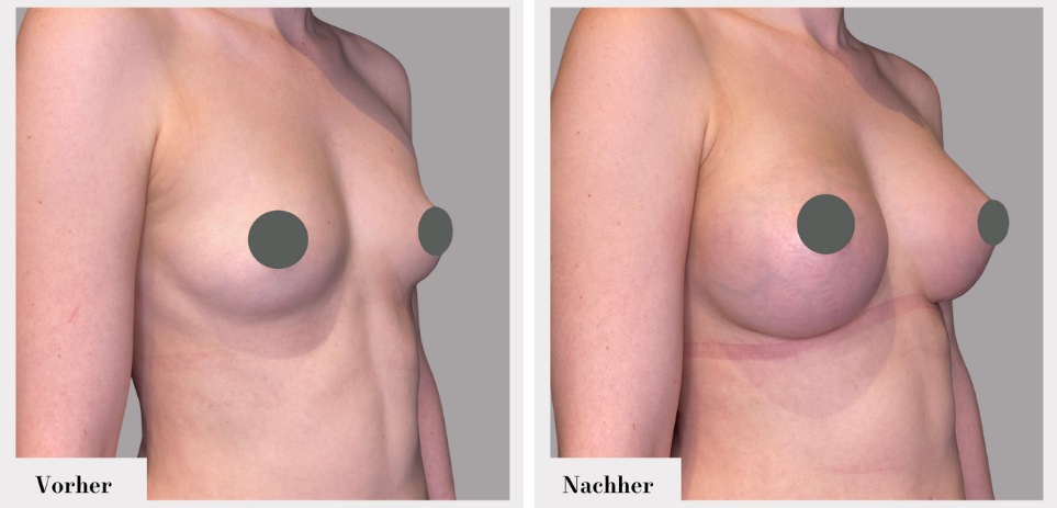 Brustvergrösserung vorher nachher implantate