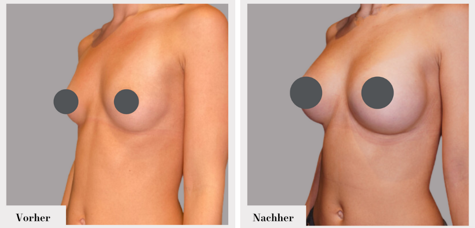 Brustvergrösserung vorher nachher implantate