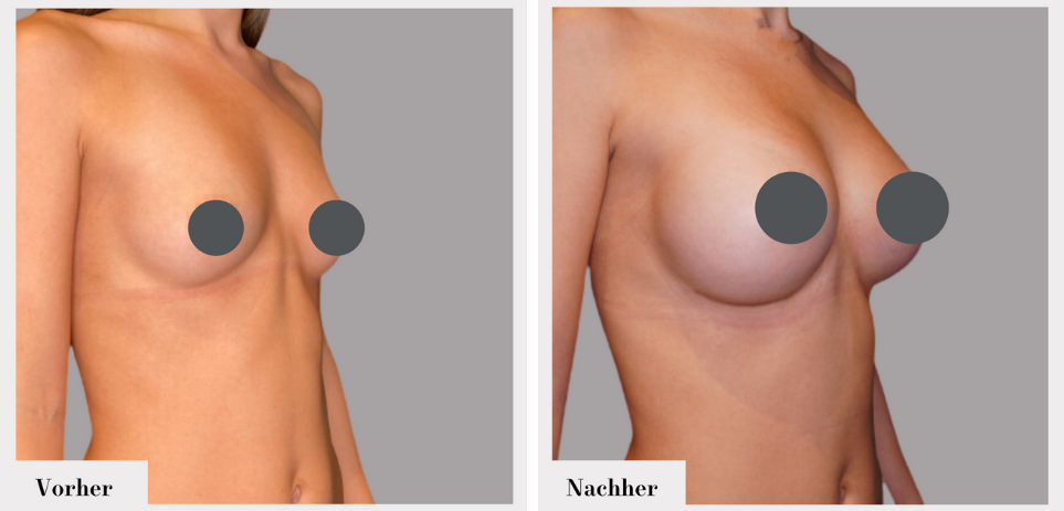 Brustvergrösserung vorher nachher implantate