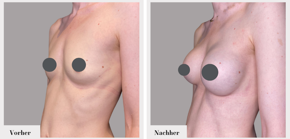 Brustvergrösserung vorher nachher implantate