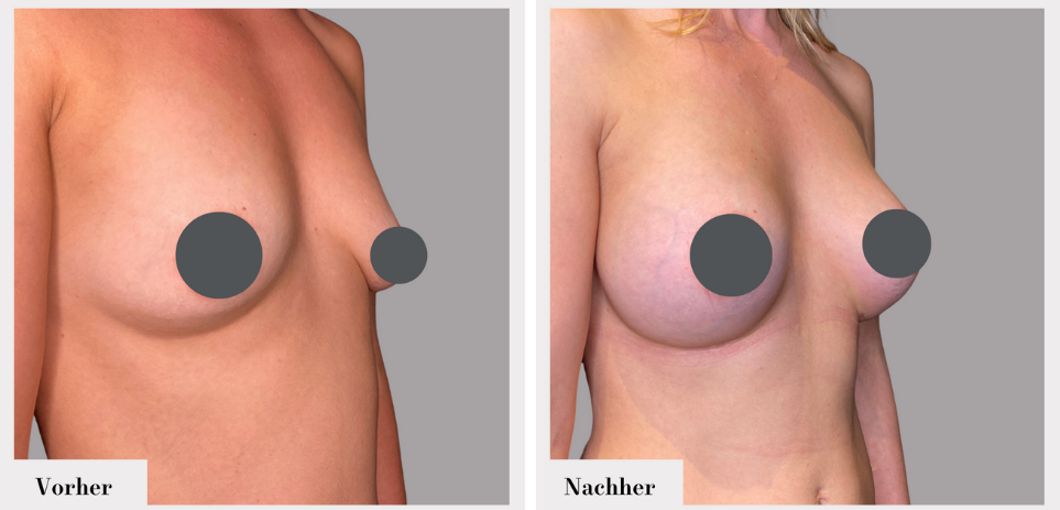 Brustvergrösserung vorher nachher implantate