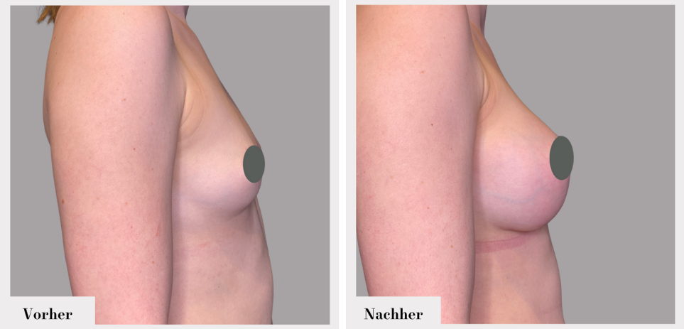 Brustvergrösserung vorher nachher implantate
