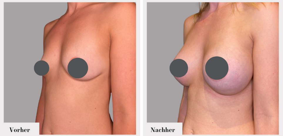 Brustvergrösserung vorher nachher implantate