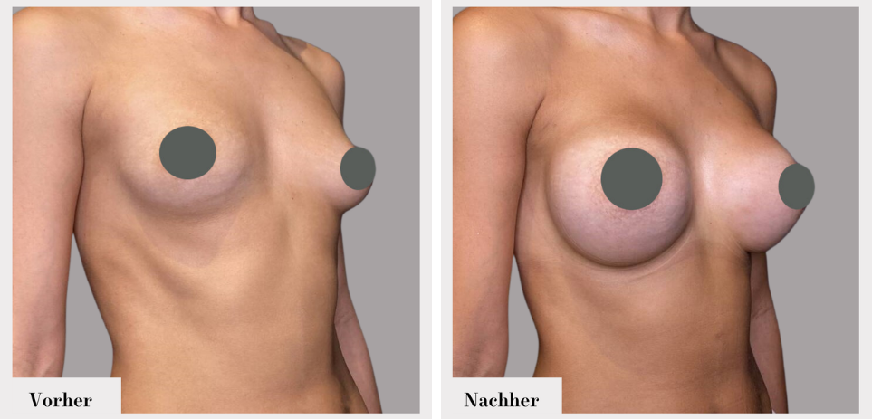 Brustvergrösserung vorher nachher implantate