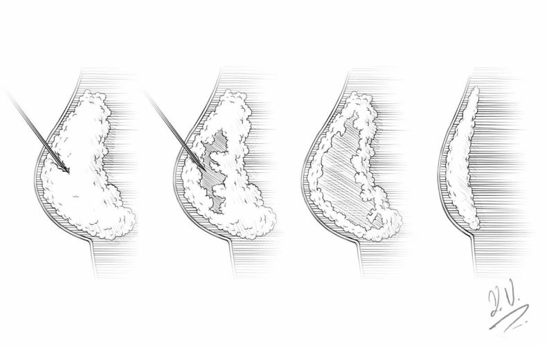 Injection lipolysis in Zug