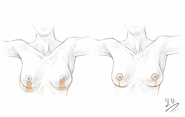 Breast Aesthetics