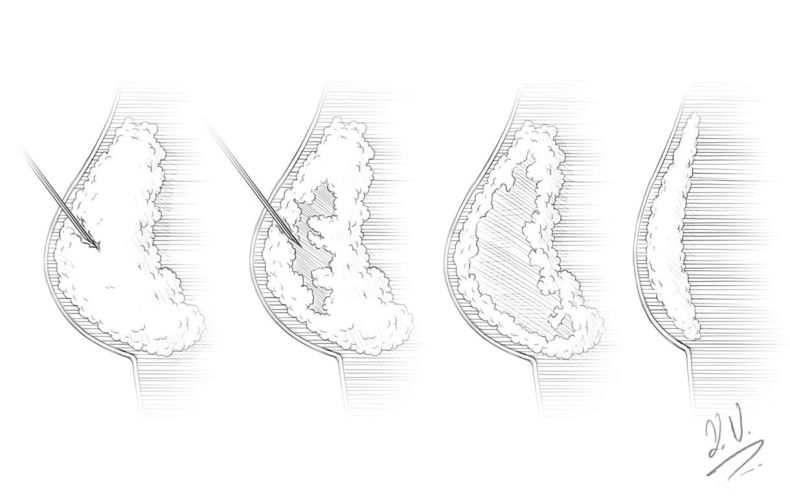 fettweg-spritze-in-zug