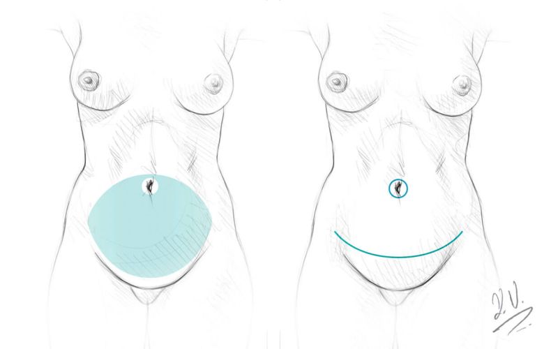 Tummy Tuck