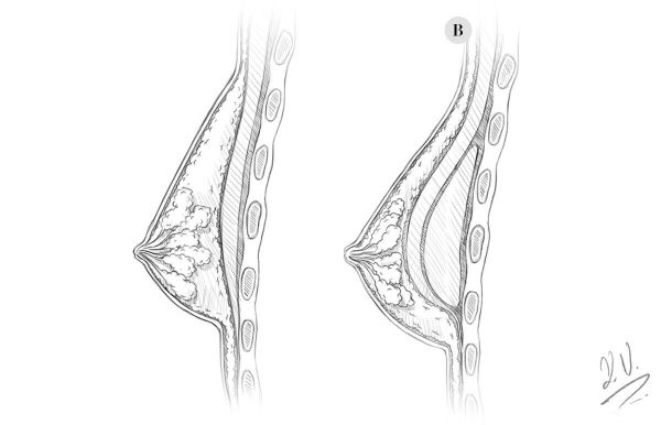 Brust OP unterhalb des Muskel
