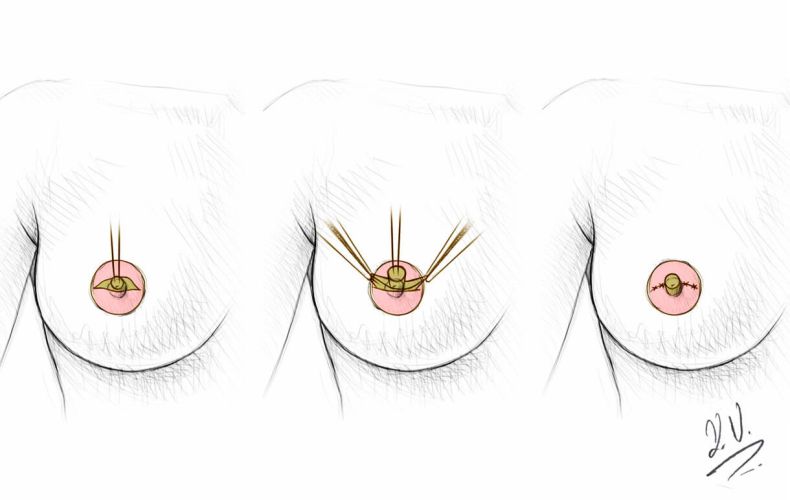 Brustwarzenkorrektur