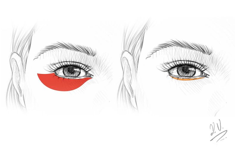 Augenlidstraffung in Zug - Luzern