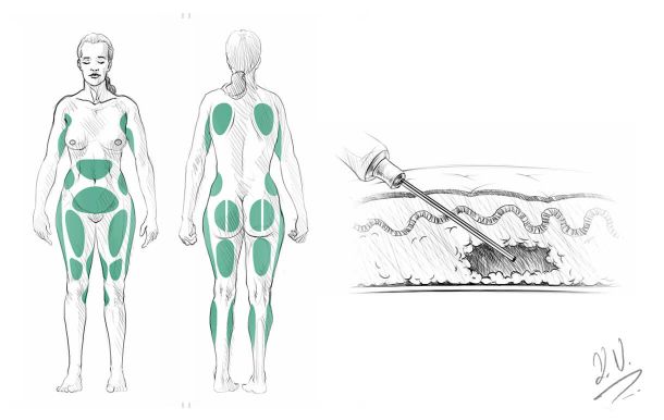 Liposuction, Liposuktion