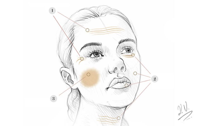 dermafiller