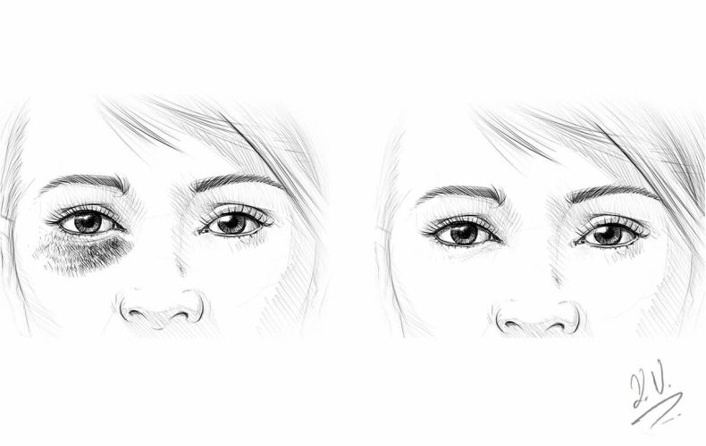 Augenringe behandeln bei Dr. Kelly in Zug