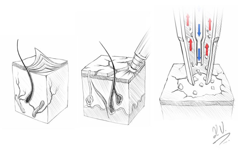 Dermaabrasion