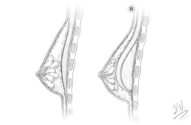 Brust OP unterhalb des Muskel