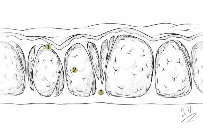 Cellulite bei Dr. Kelly